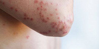 Rośnie liczba przypadków odry. Już 18 osób chorych-30376