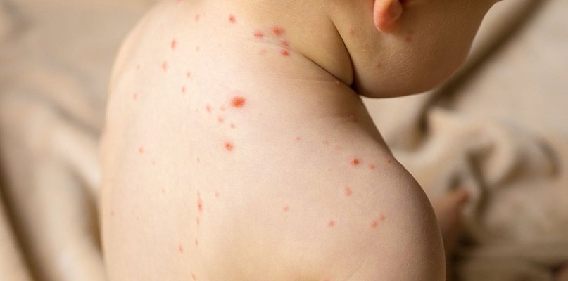 11 przypadków odry, sanepid prowadzi dochodzenie epidemiologiczne - 30357